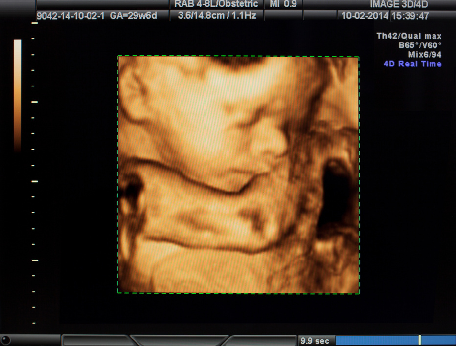 Ultrasound 3D