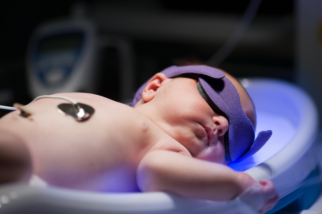 Newborn Baby Receiving Uv Phototherapy