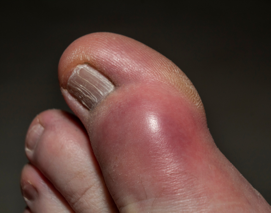 Gout in the left big toe