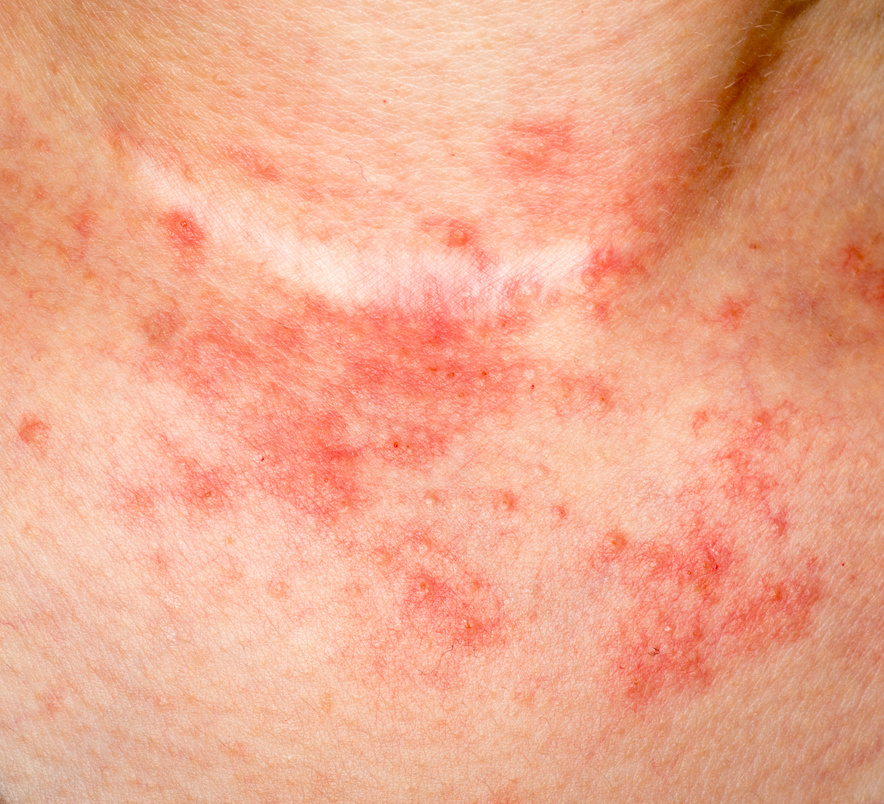 eczema skin on neck