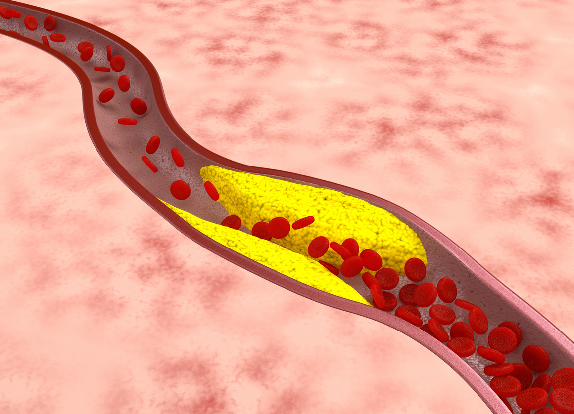 Atherosclerosis