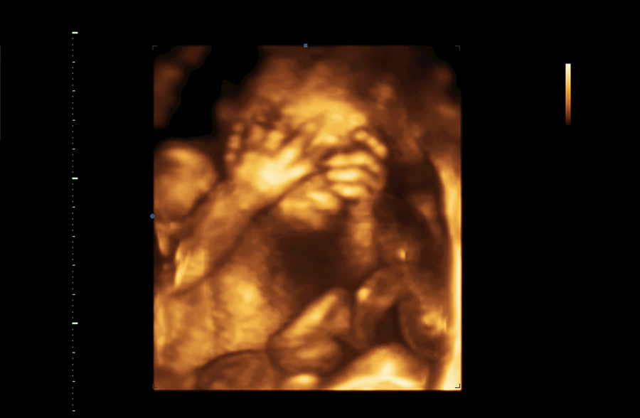 Baby 3D ultrasound 6 month